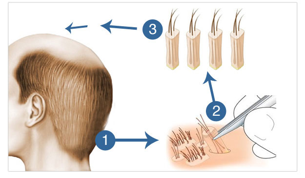 13 benefits of hair transplant
