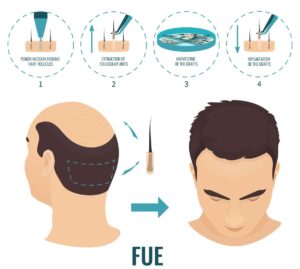 fue hair transplant at Face value clinic
