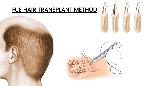 what is fue hair transplant?