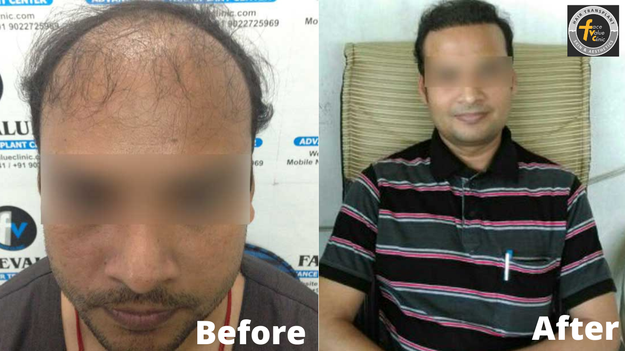 Best Hair Transplant trichology in chennai|Center , Clinic - Face Value  trichology