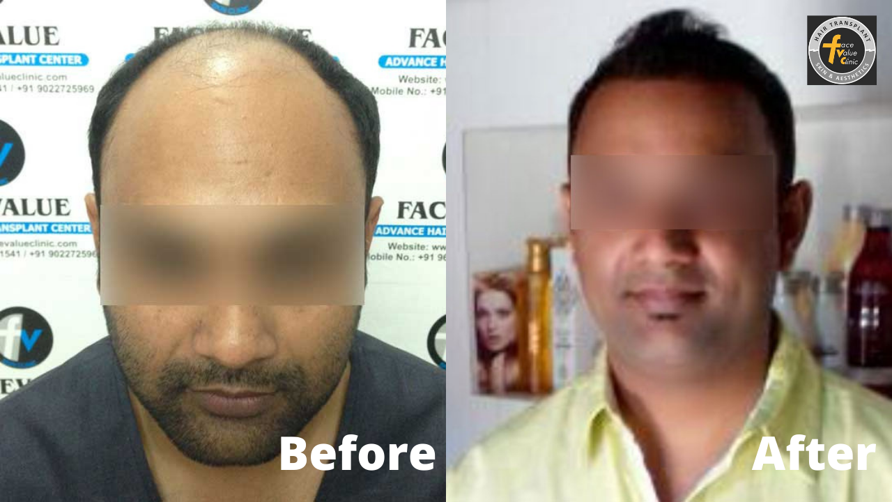 Best Hair Transplant trichology in chennai|Center , Clinic - Face Value  trichology