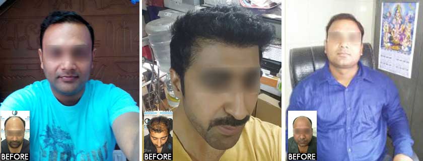 Before and After FUE hair transplant in Ghatkopar | face value clinic 4