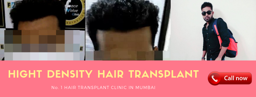 high density hair transplant | face value clinic 4