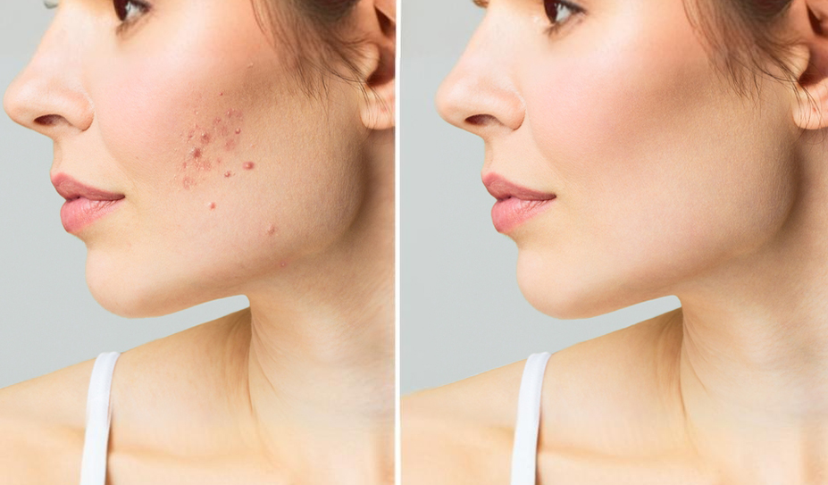 Acne Scar Treatment - Face Value