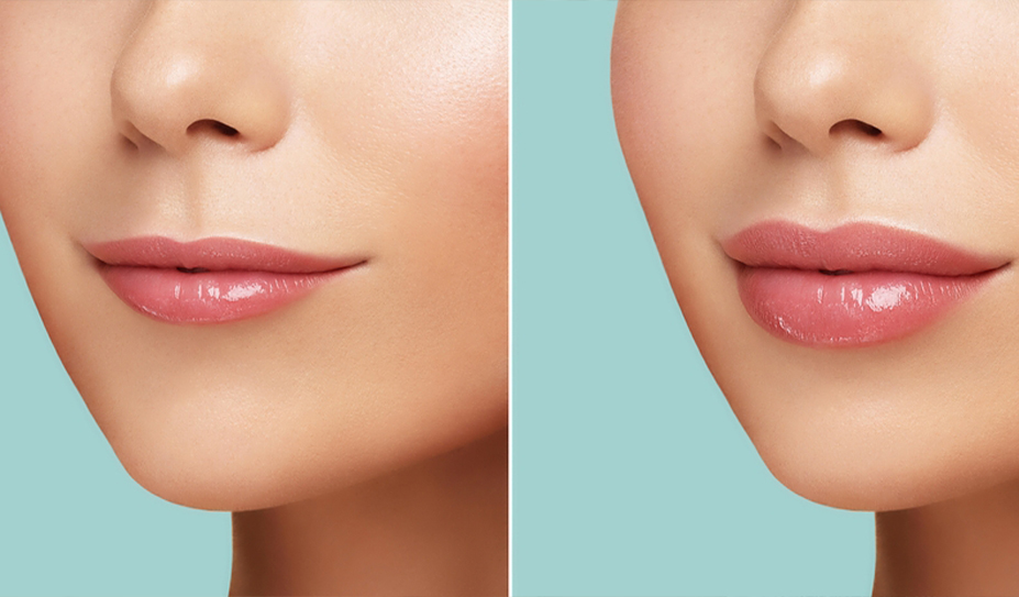 Fillers Treatment - Face Value