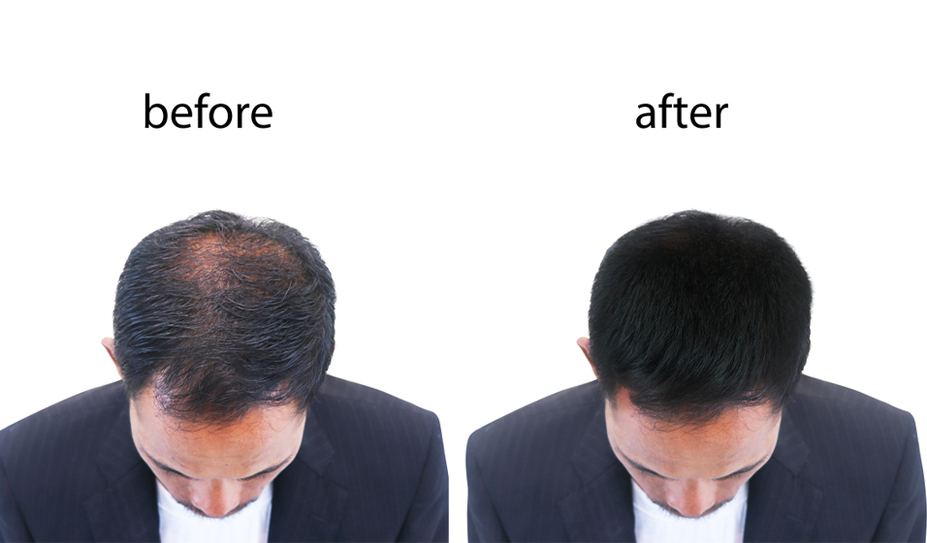 Hair Thinning Treatment - Face Value