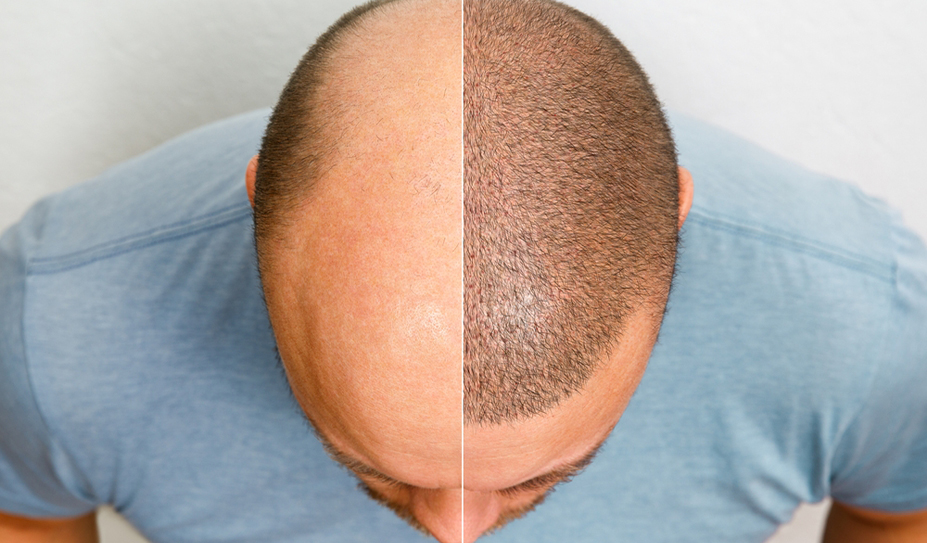 Hair Transplantation - Face Value