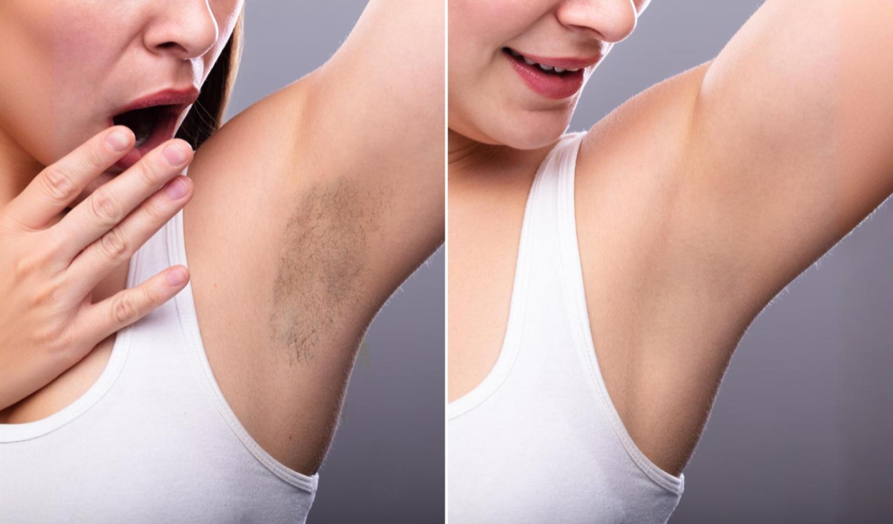 Laser Hair Removal - Face Value