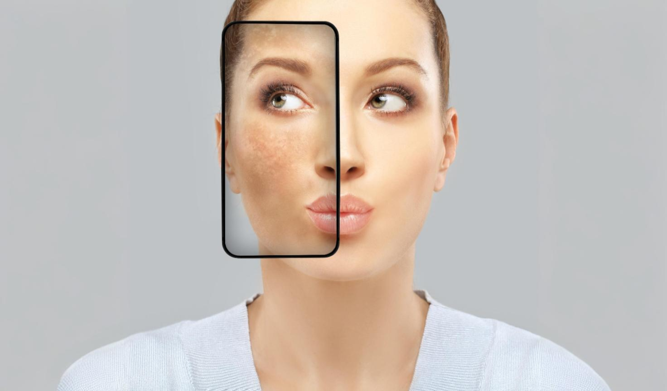 Melasma Removal Treatment - Face Value