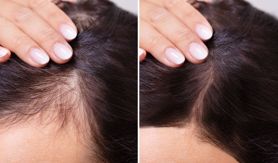 Hair Fall Treatment - Face Value