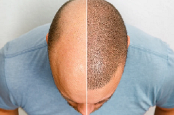 Hair Transplantation